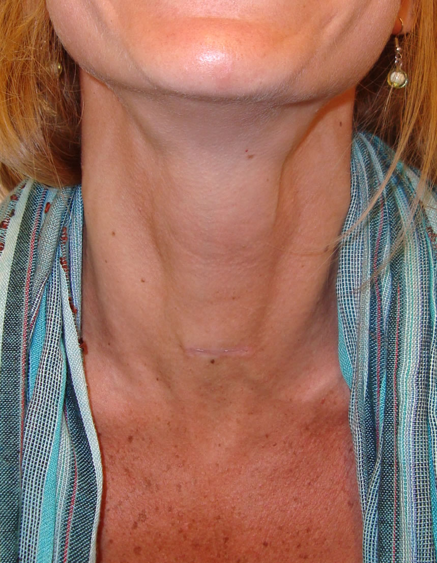 Cirugia Tiroides - Cicatriz Estetica